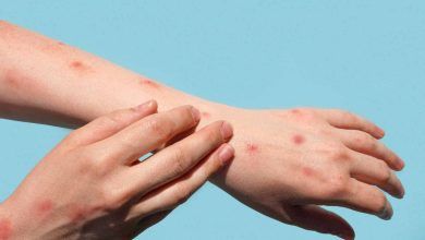 South Africa Reports Second Mpox Death This Week