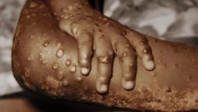 Cross River, Lagos Lead as Mpox Spreads Across 63 LGs